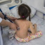 Measles cases surge in 2023 infecting 10.3 million people worldwide